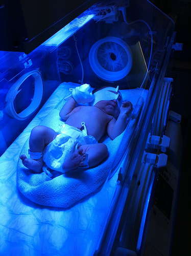 Alex having photo therapy Alex having photo therapy